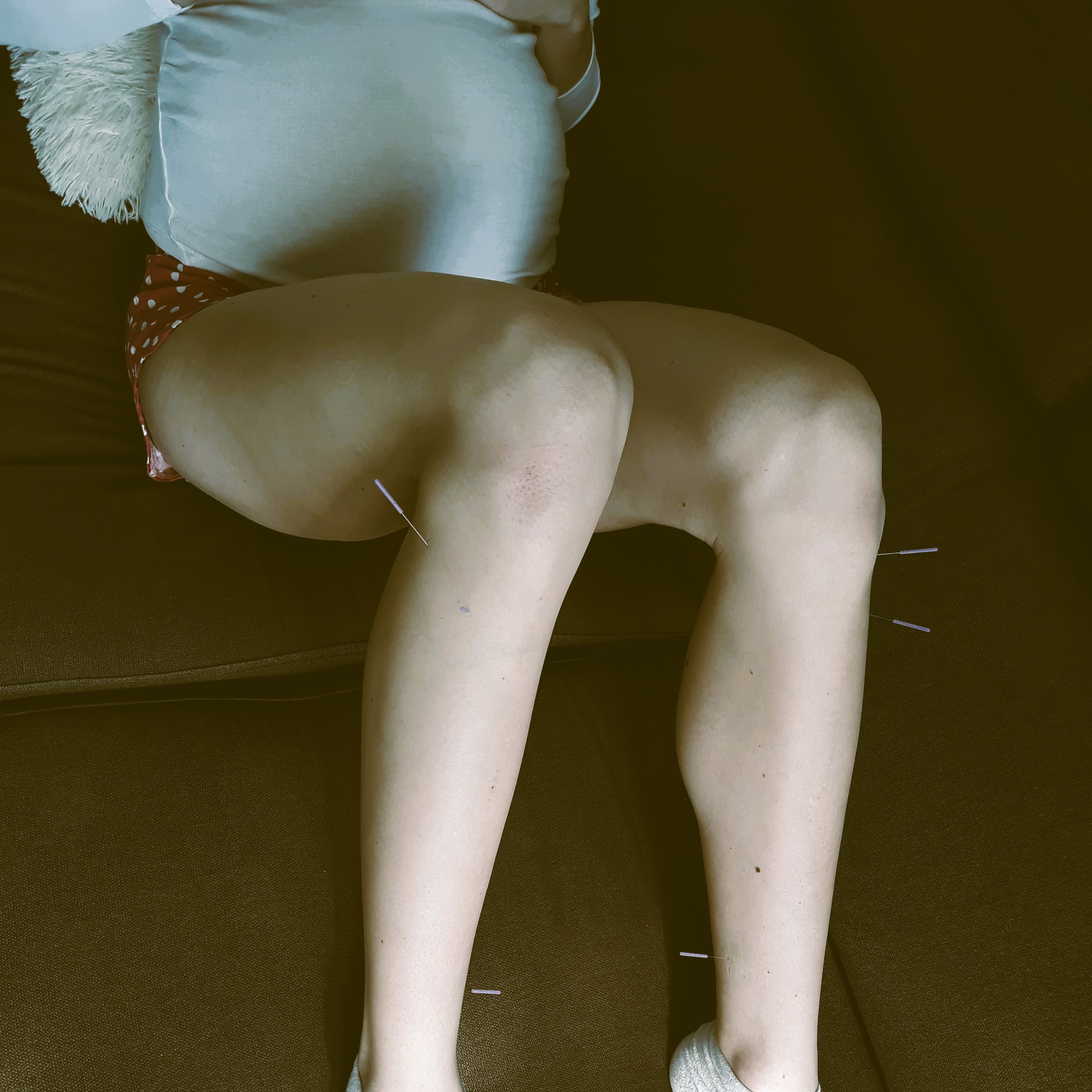 Akupunktúra – príprava na pôrod